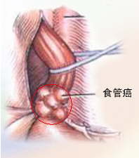 食道癌