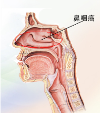 鼻咽癌