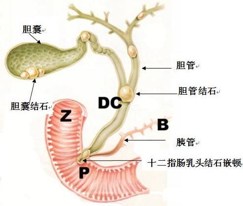 胆管癌