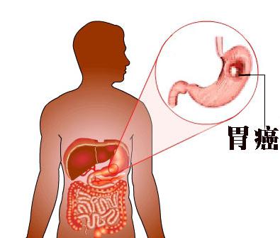 胃炎与胃癌的症状