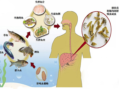 胆管癌晚期症状